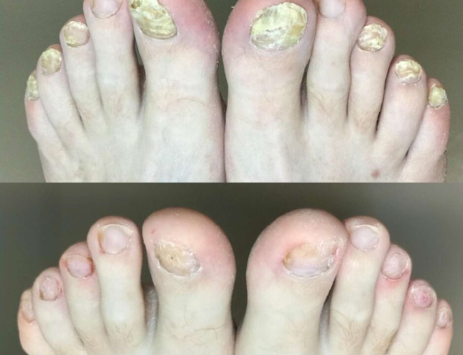 Before and after treatment, fungal promisil cream