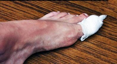 Compress to treat fungus in the toes