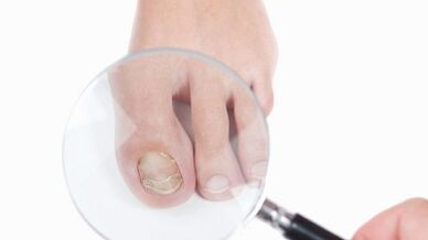 How to treat fungus in the toes