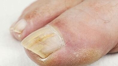 Reason -as a fungal appearance in the toes