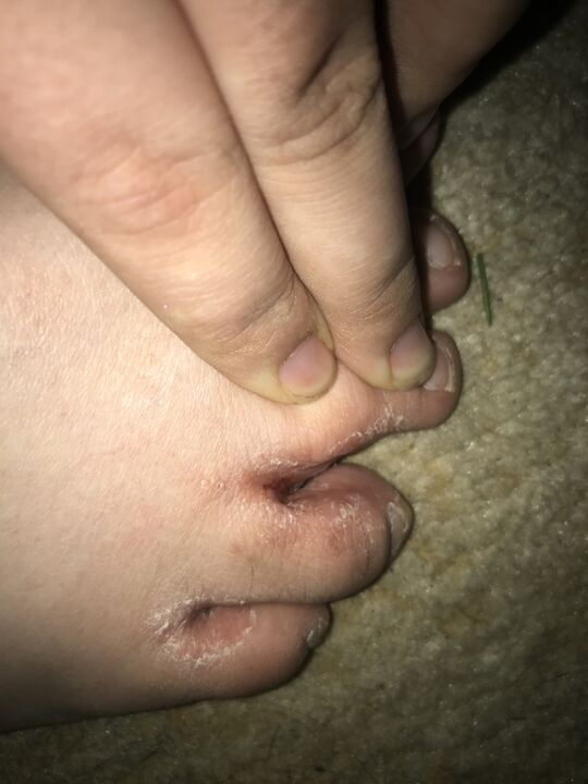 Fungal infection of the feet