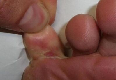 cracked feet due to fungal infection