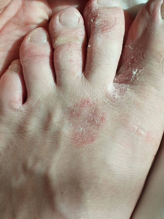fungus between the toes