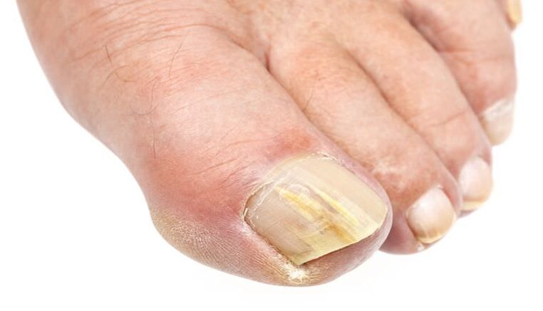 External changes in the nails are a sign of a fungal infection