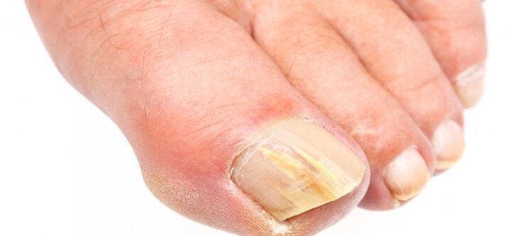 toenail fungus