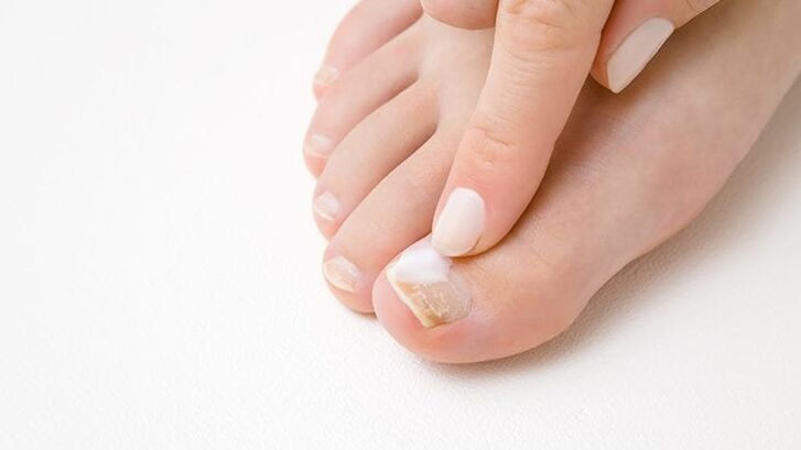 type of toenail fungus