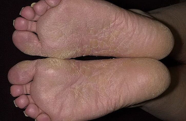 Dry and flaky skin on the feet is a sign of scaly mycosis