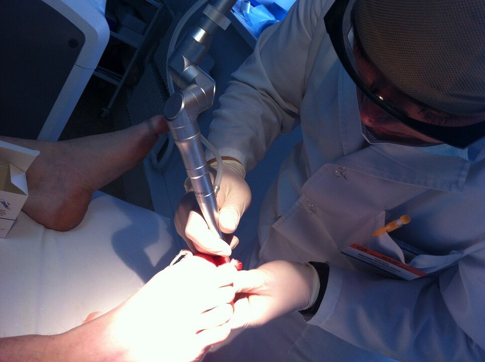 Mycosis laser treatment